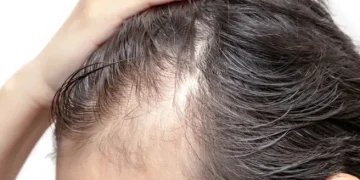 Is Stress the Reason Your Hair Is Thinning?