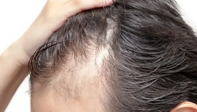 Is Stress the Reason Your Hair Is Thinning?