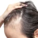 Is Stress the Reason Your Hair Is Thinning?