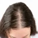 How Much Hair Loss Is Normal and When to Be Concerned